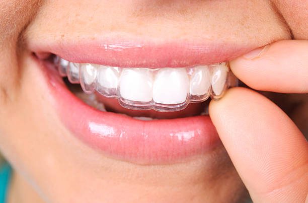 A close-up photo of a patient wearing a clear aligner.