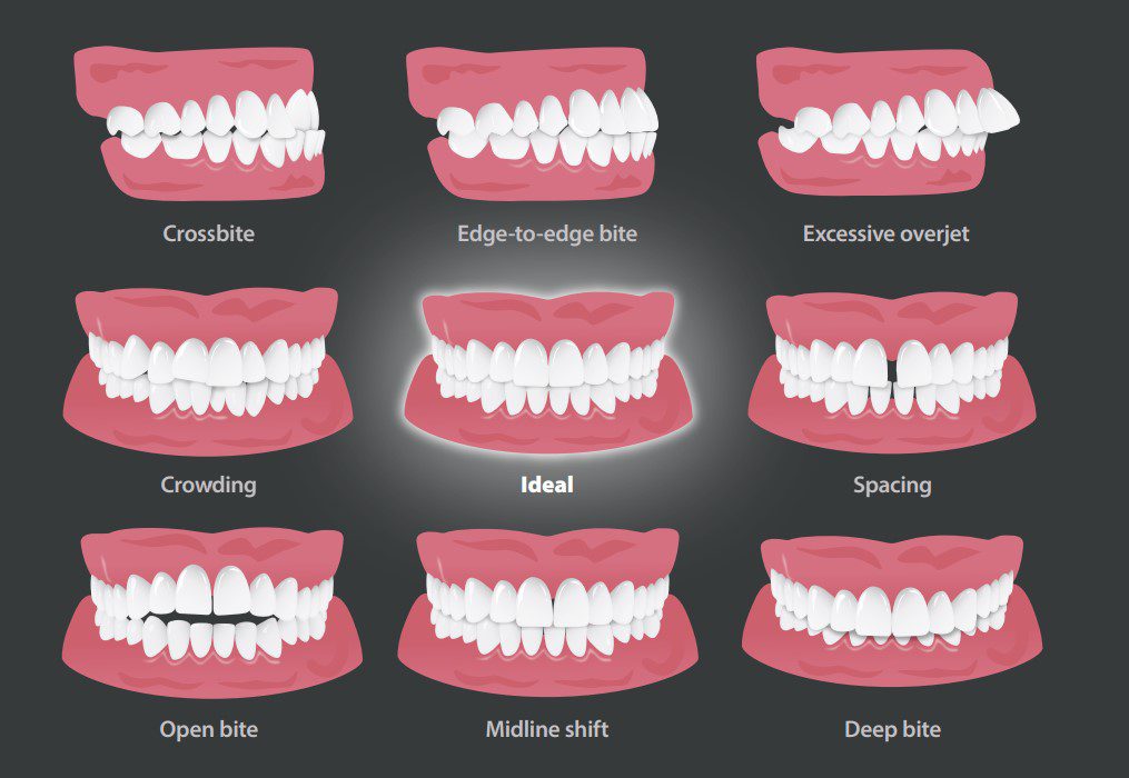 Various types of dental occlusion and alignment issues.