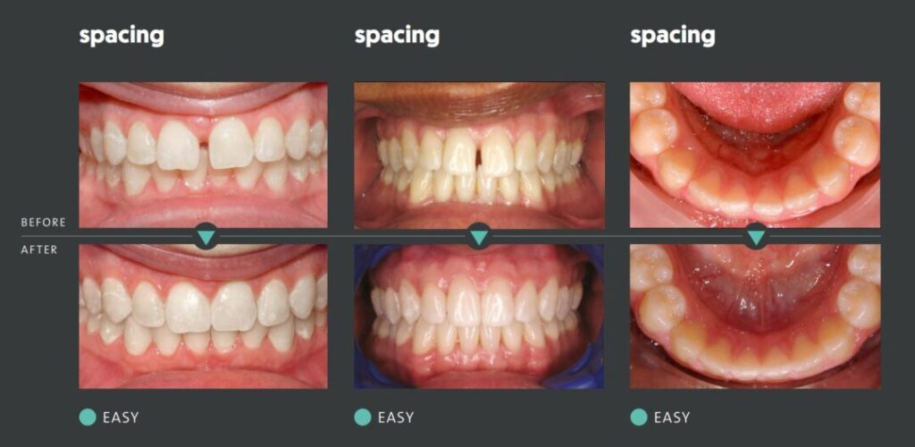 Before-and-after photos of teeth using Art of Smiles' ClearCorrect aligners